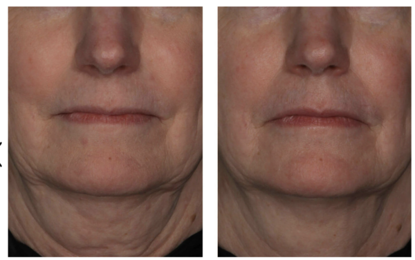 SkinBetter Science Interfuse Treatment Cream Face and Neck - Image 2